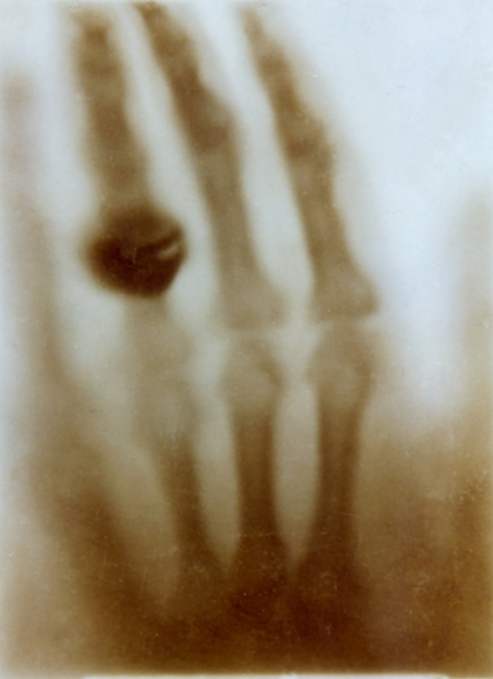 Das Röntgenbild zeigt die Handknochen von Wilhelm Röntgens Frau. Deutlich sind Mittelhand und Fingerknochen zu erkennen. Wesentlich dunkler setzt sich ein Punkt am Ringfinger der Dame ab, verursacht durch das Edelmetall des Rings.