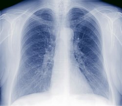Röntgenaufnahme, die Lungenflügel heben sich unter den Rippen deutlch ab.
