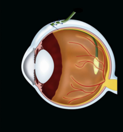 Dargestellt ist ein menschlicher Augapfel. Das Implantat wird auf der Netzhaut platziert und über ein Kabel, das durch die Haut tritt, von außen mit Strom versorgt.