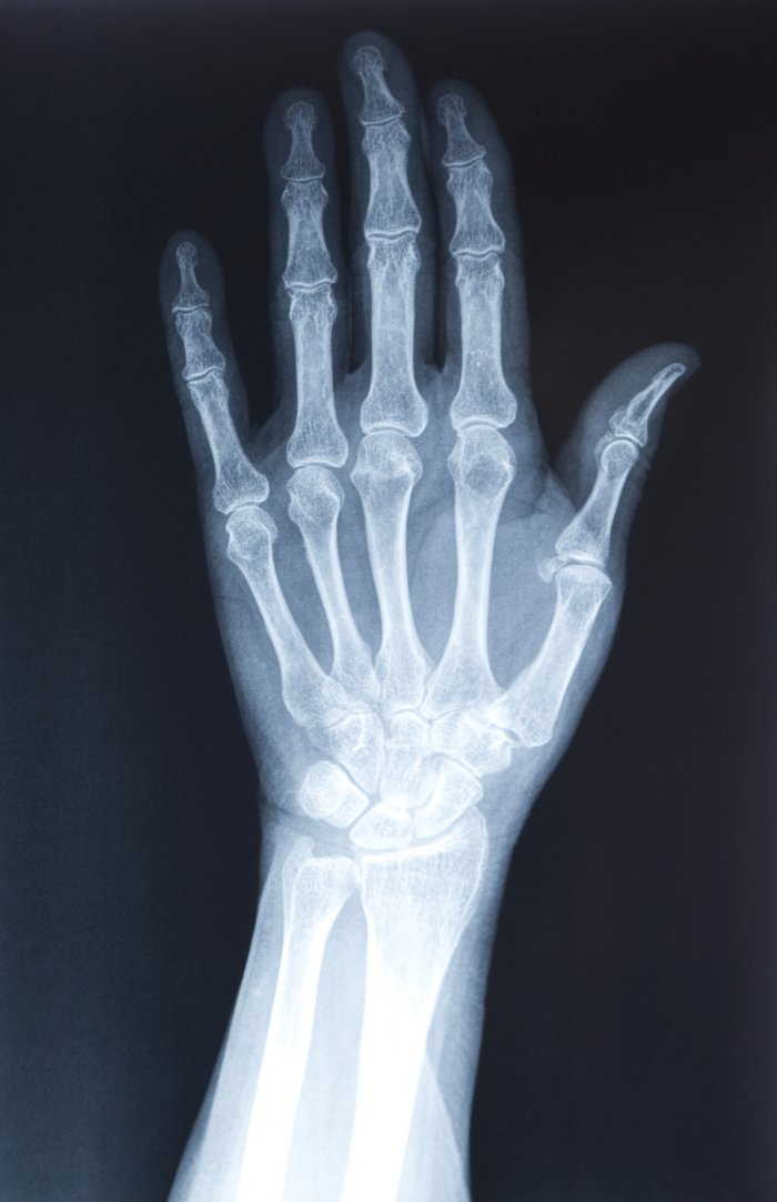 Röntgenbild, auf dem sich die Knochen der Hand weiß vor dem dunklen Hintergrund abzeichnen. Die Haut um die Knochen ist eher schwach und diffus zu erkennen.
