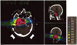 Drei schwarzweiße Röntgen- oder CT-Bilder eines Schädels, jeweils von oben, seitlich und von hinten, darüber gelegt die bunte Flächenverteilung der Dosisintensitäten mit rotem Zentrum und dunkelblauem Rand. Rechts Intensitätenskala von rot = 90 bis dunkelblau = 10.