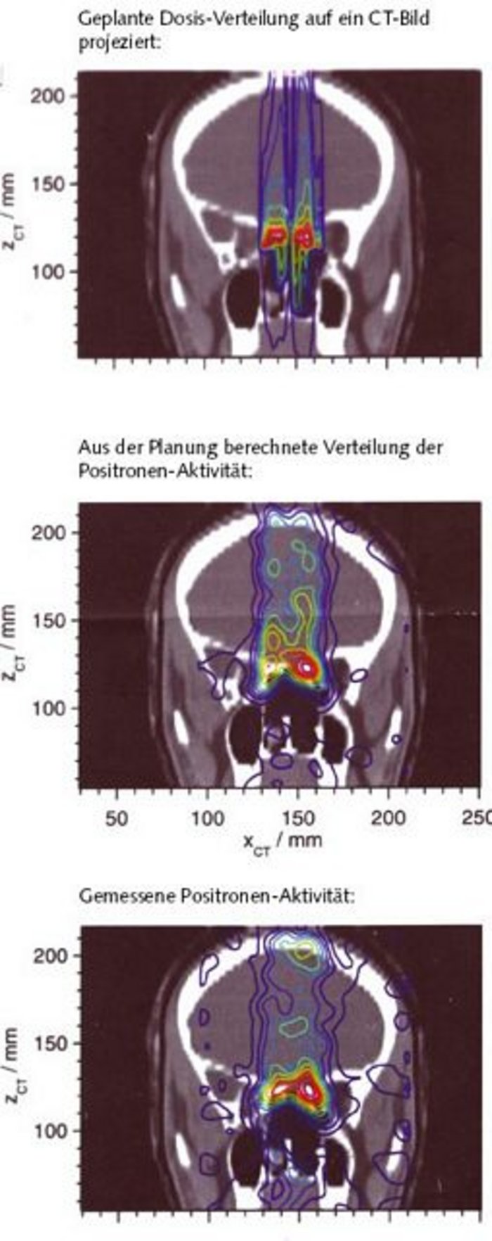 Drei Grafiken übereinander: jeweils gleiches Schädel-Röntgenbild mit übergelagerten bunten Bereichsumrissen. Werte für ZCT/mm aufgetragen gegen XCT/mm. Beschriftung 1.Bild "Geplante Dosis-Verteilung auf ein CT-Bild projiziert", senkrechte blaue Bereichslinien über ganze Höhe in zwei "Säulen", mittig in kleineren grünen, dann gelben, dann roten Bereich übergehend. Beschriftung 2.Bild "Aus der Planung berechnete Verteilung der Positronen-Aktivität", statt zweier "Säulen" ein gemeinsamer, ähnlich breiter Bereich, seitlich ausgefranster mit einzelnen "Blasen" daneben, grüne, gelbe und rote Bereiche ähnlich wie zuvor, aber breiter, verschmolzener. Beschriftung 3. Bild "Gemessene Positronen-Aktivität", Linien in etwa wie zuvor, noch mehr seitliche blaue Blasen, grün-gelb-roter Kernbereich sehr zentriert, ähnlich 1. Bild.