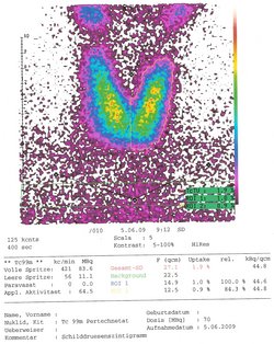 Das Szintigramm zeigt die beiden Lappen der Schilddrüse. Die Bereiche sind von außen nach innen gleichmäßig violett, bleu, grün und gelb gefärbt.