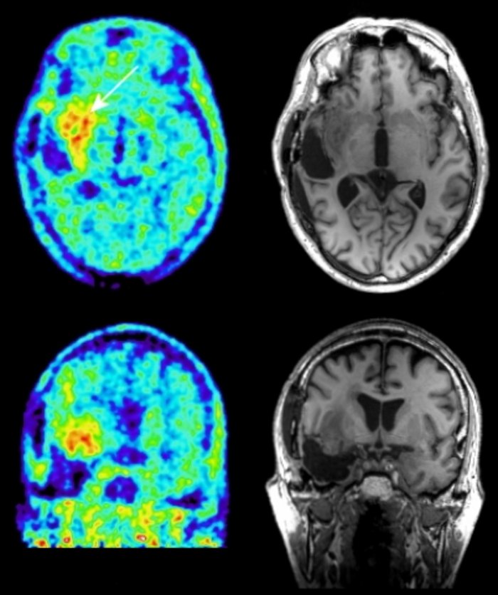 Vier Bilder vom Kopf eines Patieten, je zweimal im senkrechten und zweimal im waagrechten Querschnitt. Bei PET leuchtet das Gewebe des Gehirns in blau und grün, ein Tumor ist an seiner gleb-rötlichen Farbe zu erkennen. Die Bilder des MRT sind in schwarz-weiß, der Tumor zeichnet sich als dunkler Fleck im sonst grauen Gewebe ab.