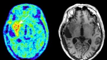 PET- und MRT-Bilder eines Gehirns