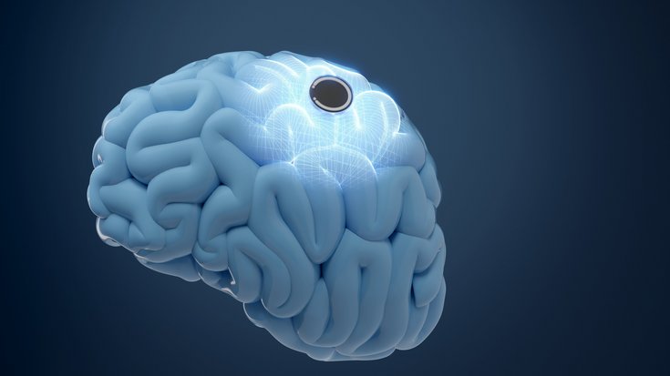 Symbolbild einer implantierten Gehirn-Computer-Schnittstelle | Bildquelle: piyaset/iStock Abstrakte Darstellung eines Gehirns, auf dem sich ein kleiner, runder Chip befindet