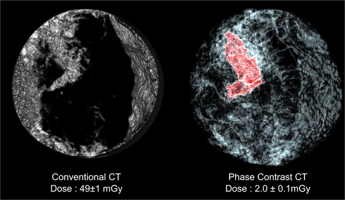 Zwei Röntgenbilder in schwarz weiß, links erscheint der mittlere Teil nur schwarz, rechts sind überall Strukturen zu erkennen. Der Tumor im rechten Bild sitzt in dem genannten ittleren Teil. Für das linke Bild mit einer herkömmlichen CT war eine Strahlung von etwa 49 Milligry nötig, für das Rechte nur 2 Milligray.