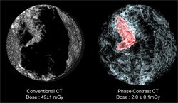 Zwei Röntgenbilder in schwarz weiß, links erscheint der mittlere Teil nur schwarz, rechts sind überall Strukturen zu erkennen. Der Tumor im rechten Bild sitzt in dem genannten ittleren Teil. Für das linke Bild mit einer herkömmlichen CT war eine Strahlung von etwa 49 Milligry nötig, für das Rechte nur 2 Milligray.