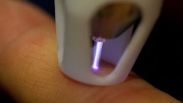 Illustration der Plasmatherapie: Durch eine Düse wird violettes Plasma in die Haus eingebracht und dringt in tiefere Schichten vor, wie man durch den Querschnitt durch die Haut sehen kann.