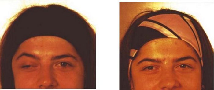 Tumorpatientin vor und nach der Bestrahlung Zwei Fotos der oberen Gesichtshälfte einer Frau mit Kopfband: links linkes Auge (vom Betrachter aus) halb geschlossen und abwärts blickend, Braue leicht erhöht; rechts mit beiden Augen in die Kamera blickend.