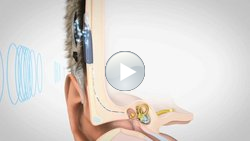 Grafik  mit Cochlea-Implantat am menschlichen Ohr